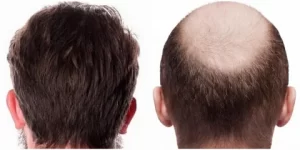 What is Fue Hair Transplant