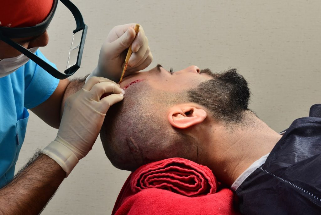 Hair Transplant Treatment