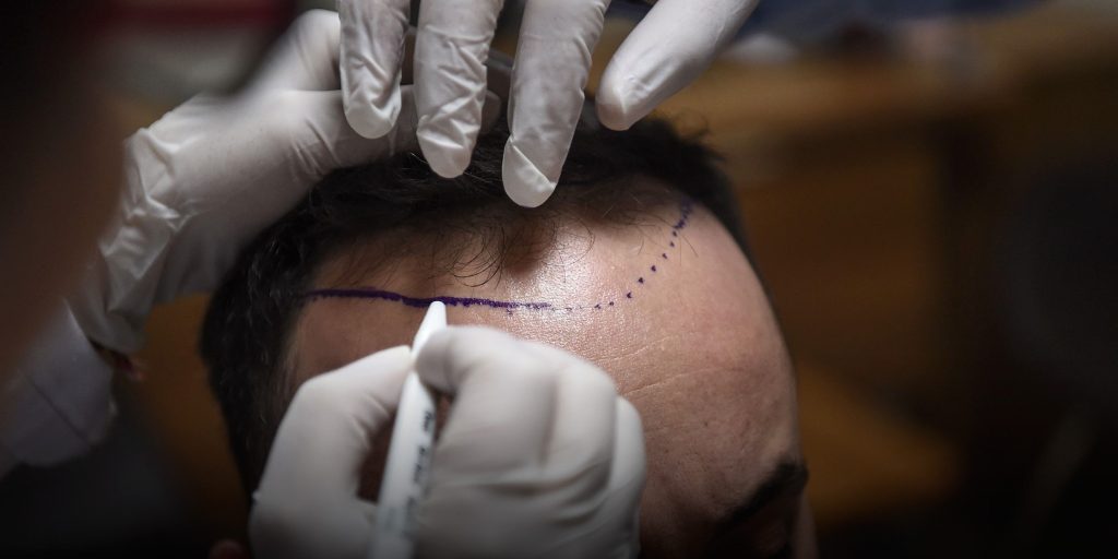 Hair Loss Treatments