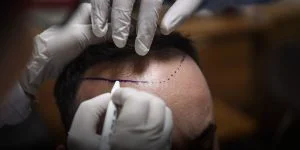 Hair Loss Treatments