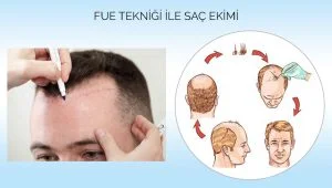 Saç Ekiminde Kullanılacak Yöntemler